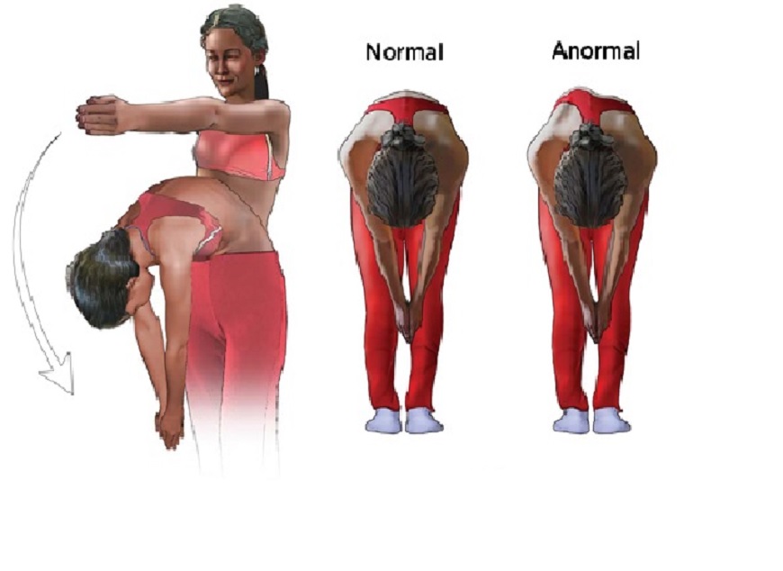 Escoliosis: síntomas y causas que necesitas conocer - Sanicor Ortopedias