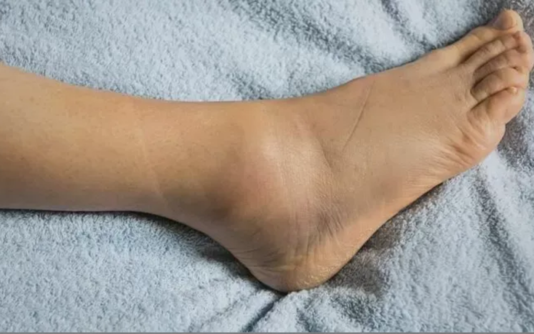 Prevención de esguinces y torceduras en el deporte