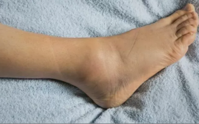 Prevención de esguinces y torceduras en el deporte