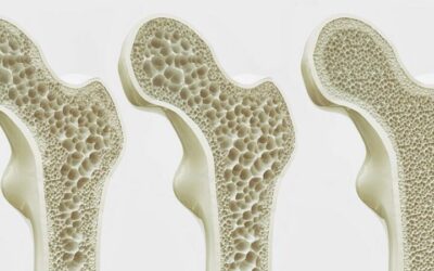 Osteoporosis: Preguntas frecuentes y consejos esenciales