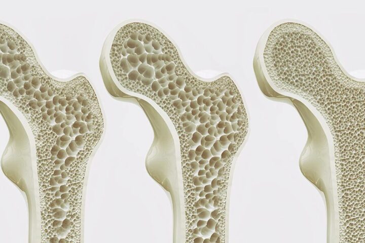 Osteoporosis: Preguntas frecuentes y consejos esenciales